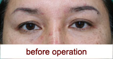 plastic-surgery-blepharoplasty